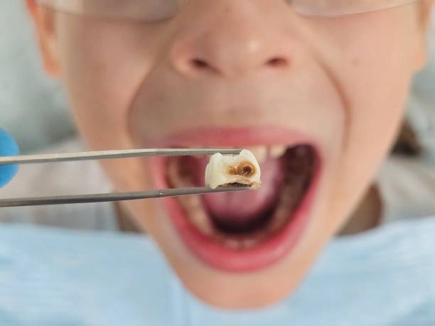 Best Emergency Gum Treatment in Carol Stream, IL